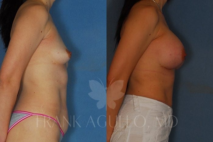 Breast Augmentation Before and After 3