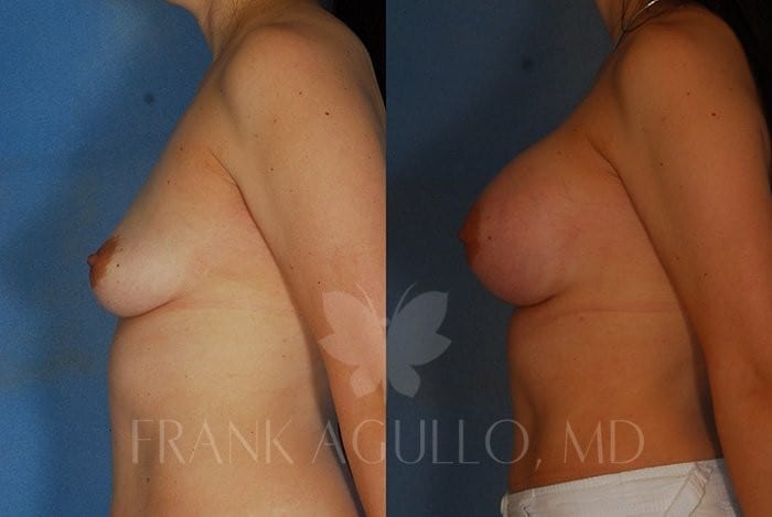 Breast Augmentation Before and After 4