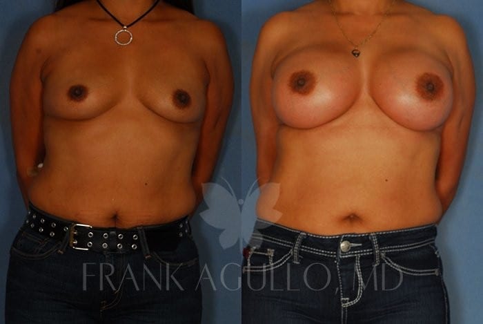 Breast Augmentation Before and After 9