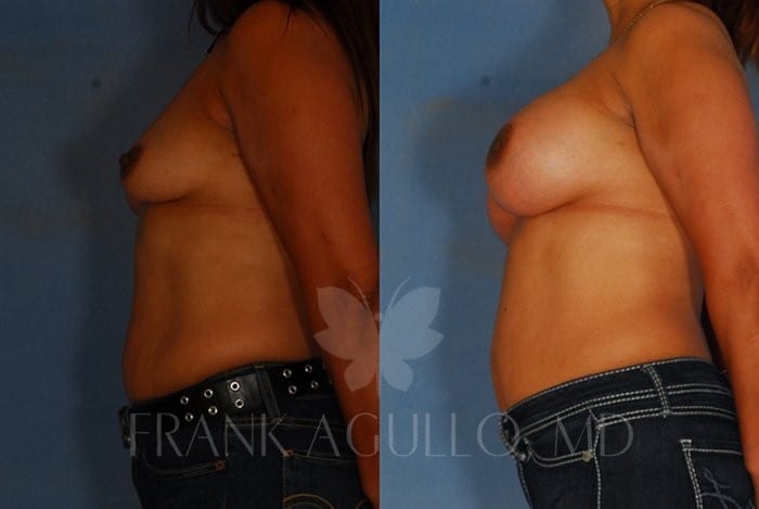 Breast Augmentation Before and After 3