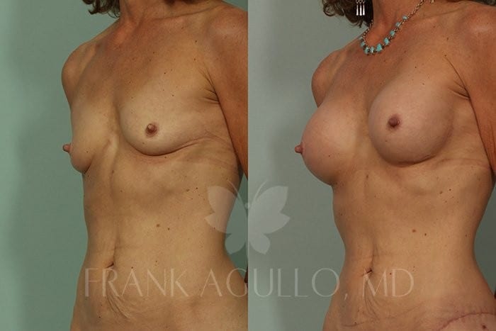 Breast Augmentation Before and After 2