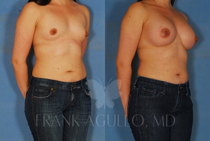 Breast Augmentation Before and After 17