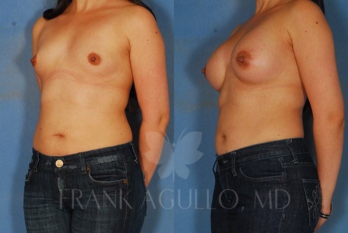 Breast Augmentation Before and After 2