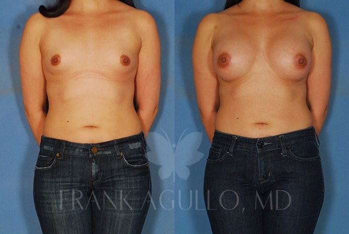 Breast Augmentation Before and After 4