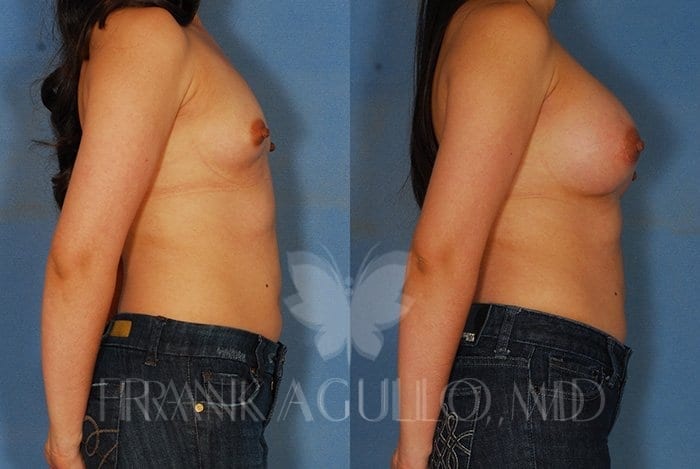 Breast Augmentation Before and After 3