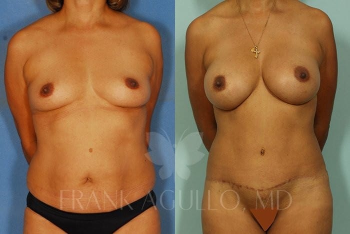 Breast Augmentation Before and After 16