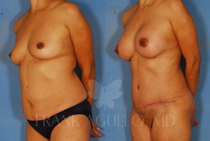 Breast Augmentation Before and After 3