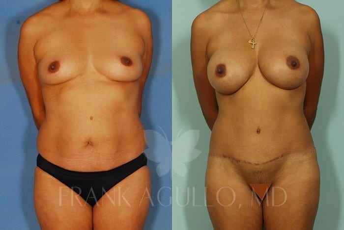Breast Augmentation Before and After 4