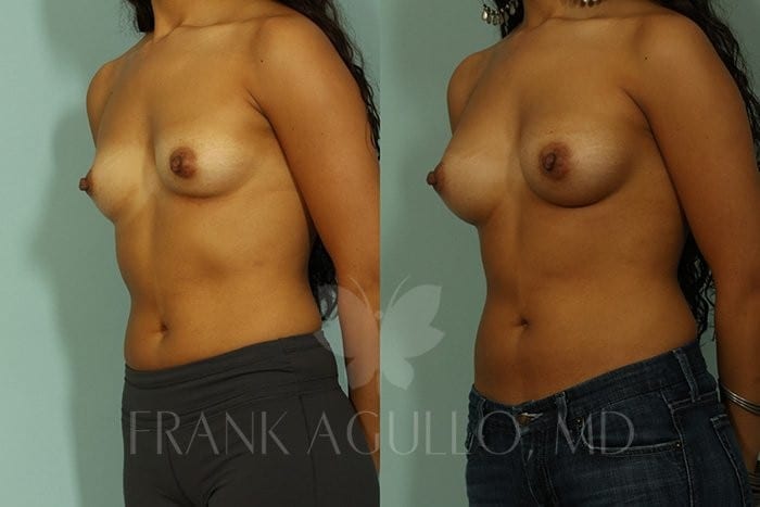 Breast Augmentation Before and After 4