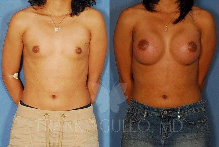 Breast Augmentation Before and After 14