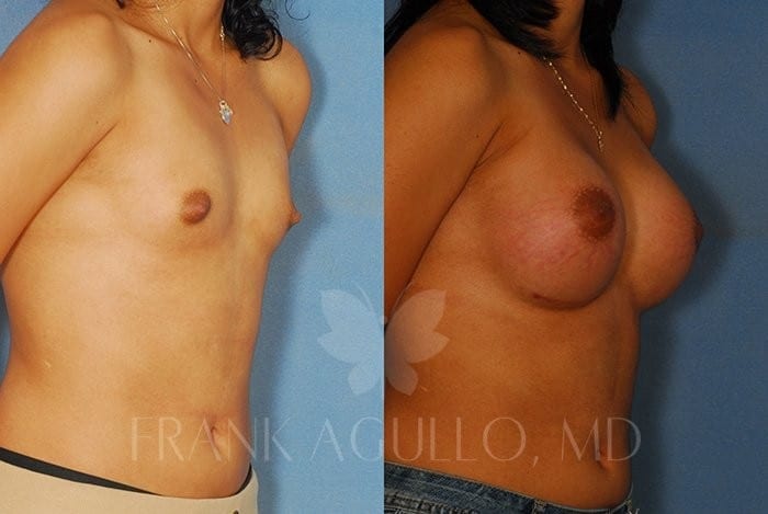 Breast Augmentation Before and After 2