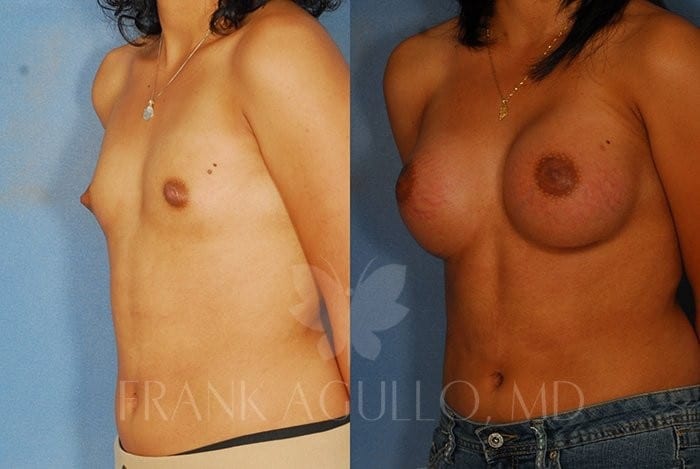 Breast Augmentation Before and After 3