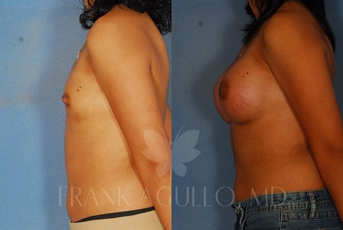Breast Augmentation Before and After 4