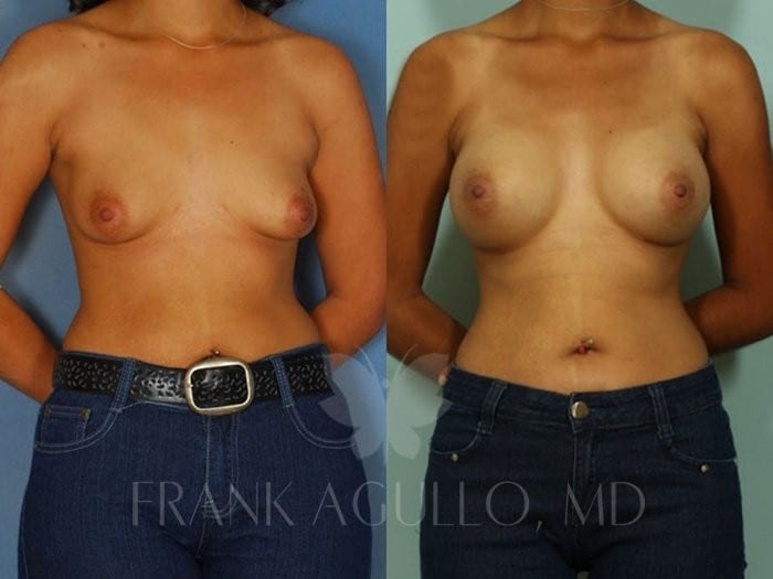 Breast Augmentation Before and After 13