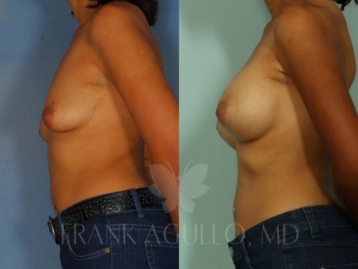 Breast Augmentation Before and After 2