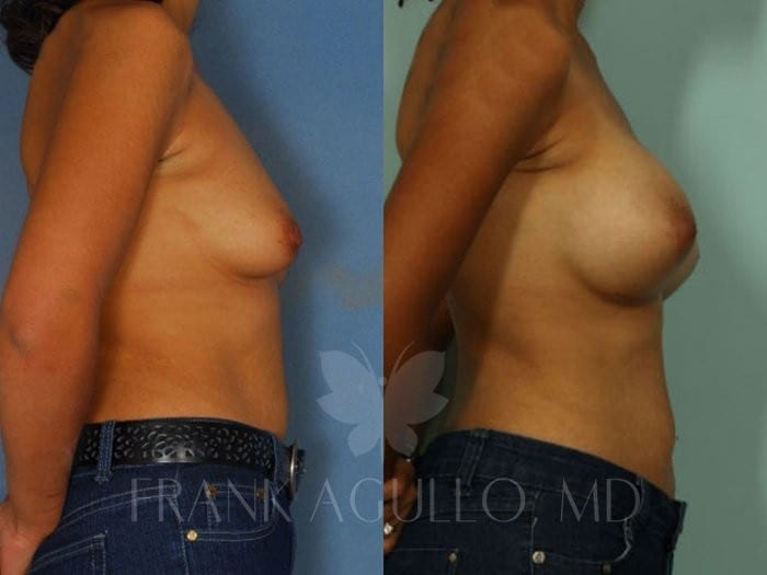 Breast Augmentation Before and After 3