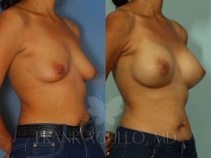 Breast Augmentation Before and After 4