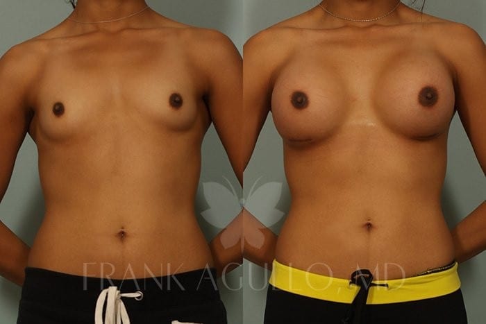 Breast Augmentation Before and After 12