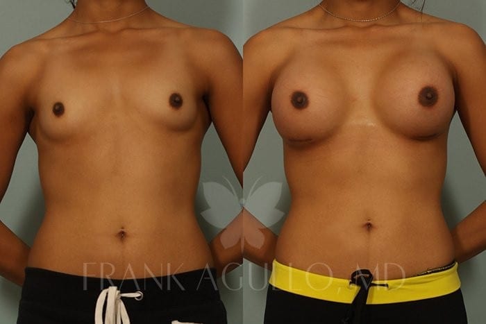 Breast Before and After 3