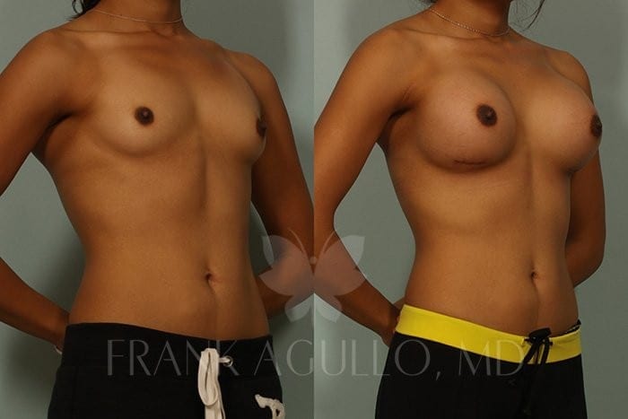 Breast Augmentation Before and After 2