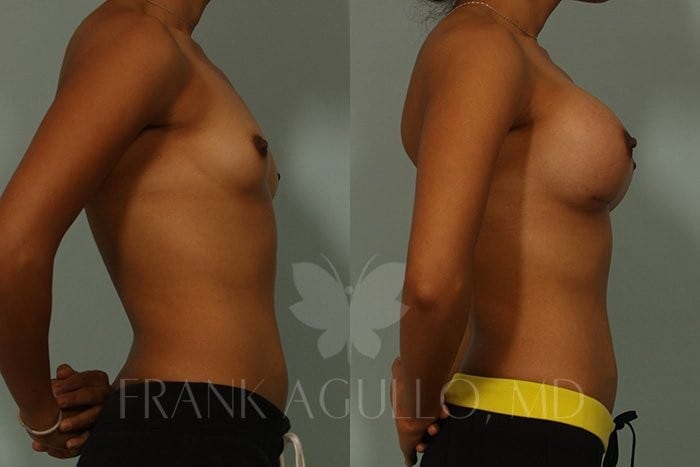 Breast Augmentation Before and After 3