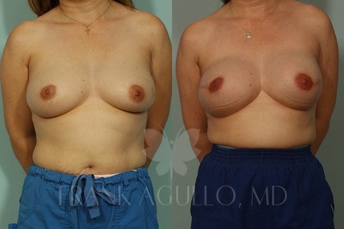 Breast Before and After 3