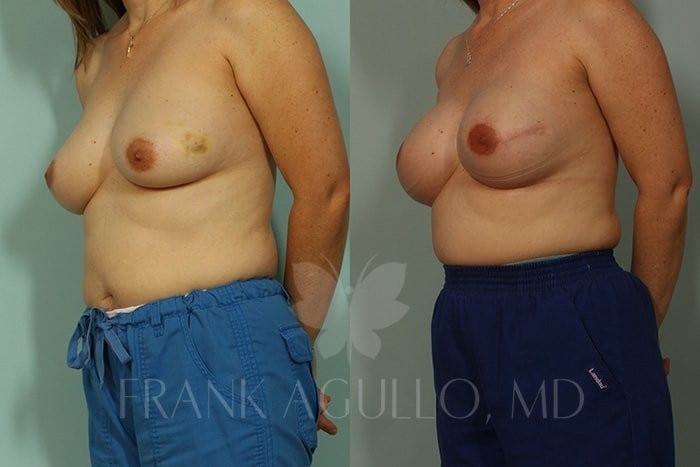 Breast Reconstruction Before and After 3