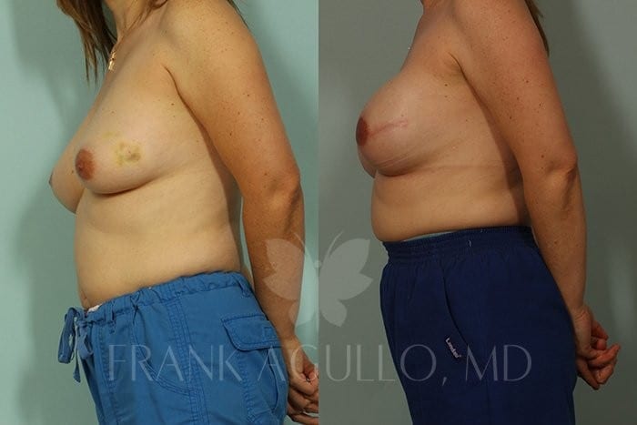 Breast Reconstruction Before and After 4