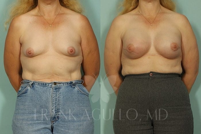 Breast Before and After 14