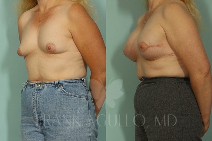 Breast Reconstruction Before and After 2