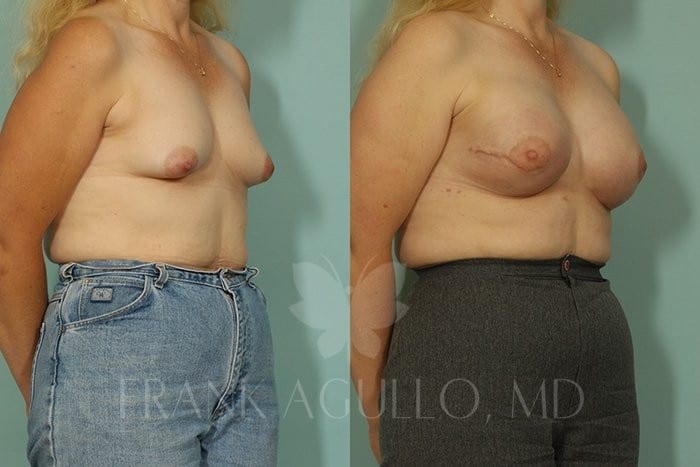 Breast Reconstruction Before and After 3