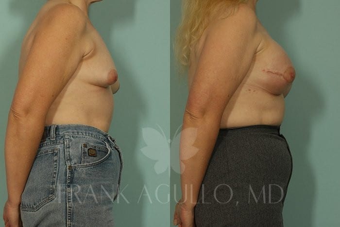 Breast Reconstruction Before and After 4