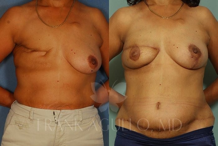 Breast Reconstruction Before and After 10