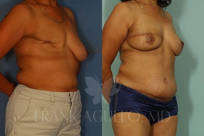 Breast Reconstruction Before and After 2