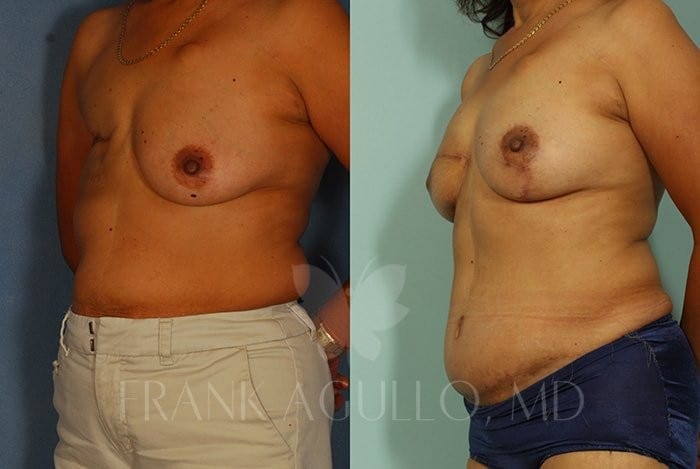 Breast Reconstruction Before and After 3