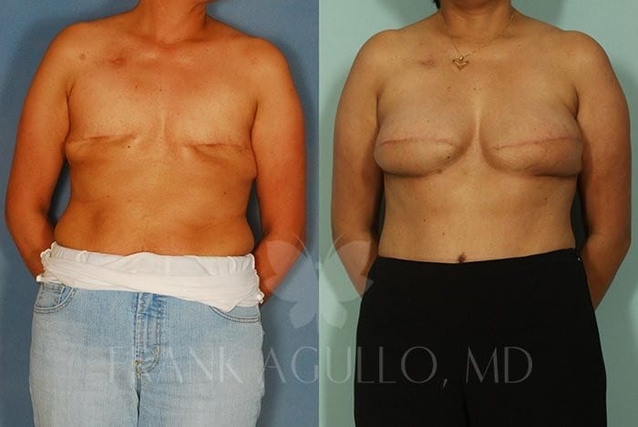 Breast Reconstruction Before and After 9