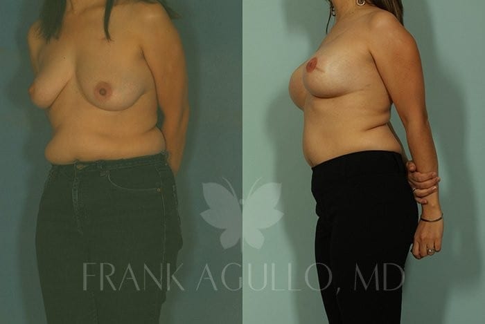 Breast Reconstruction Before and After 2