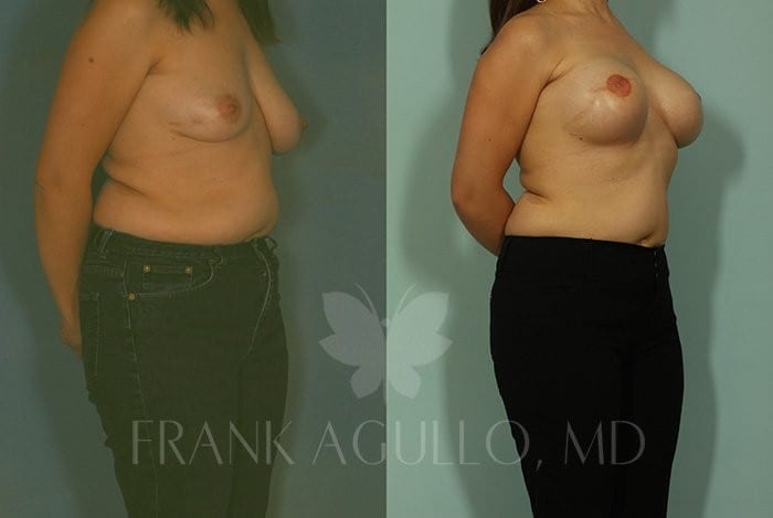 Breast Reconstruction Before and After 3