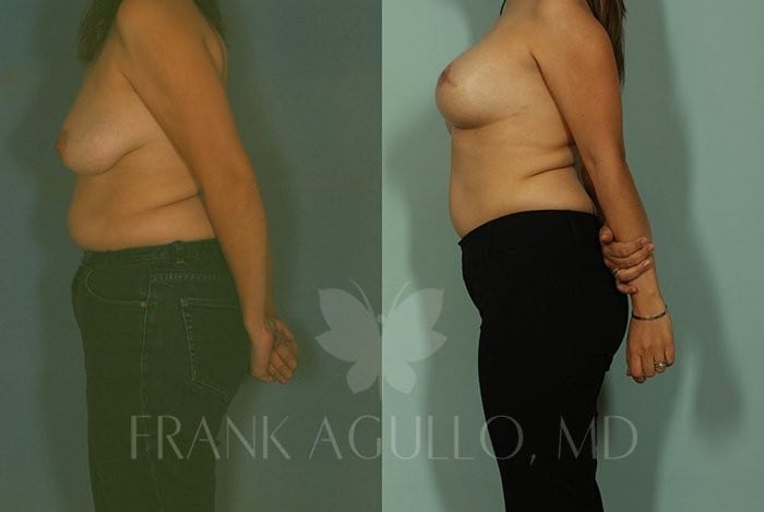 Breast Reconstruction Before and After 4