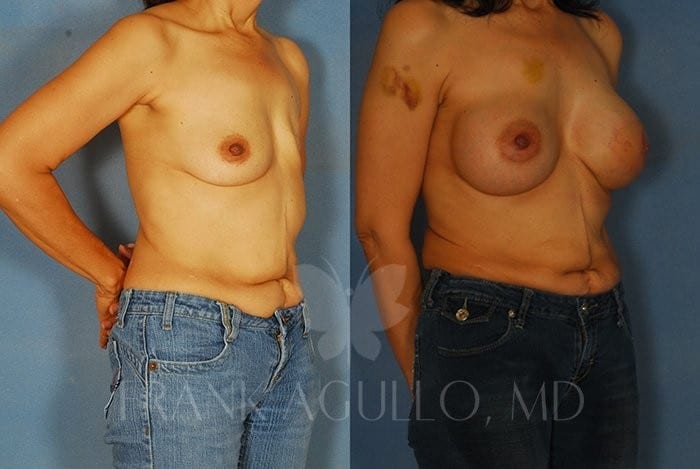 Breast Reconstruction Before and After 7