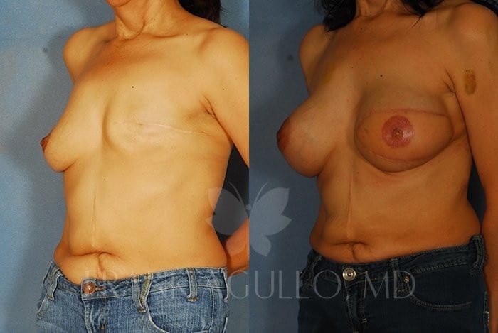 Breast Reconstruction Before and After 2