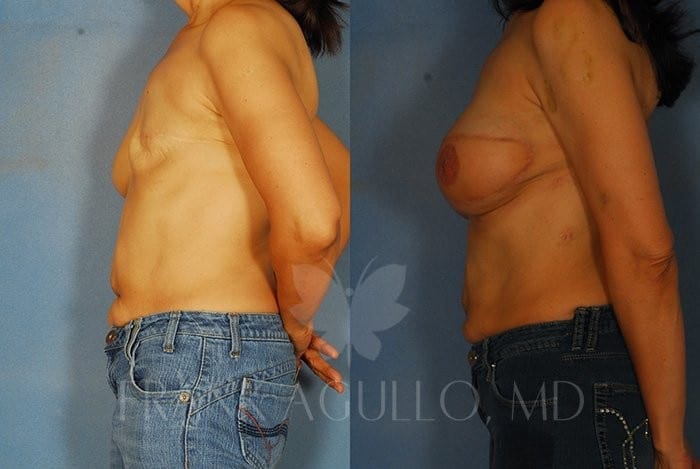 Breast Reconstruction Before and After 3