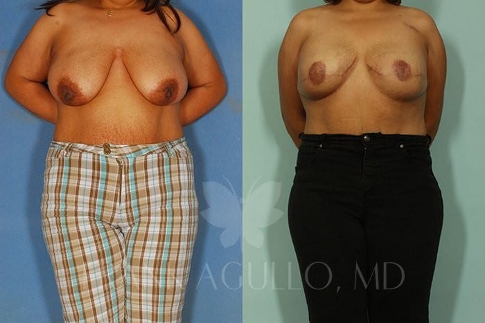 Breast Reconstruction Before and After 6