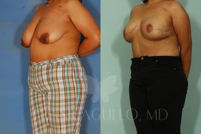 Breast Reconstruction Before and After 2