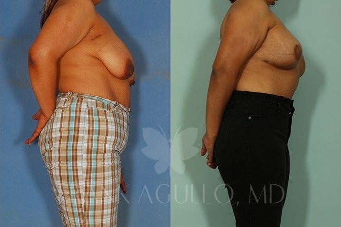Breast Reconstruction Before and After 3
