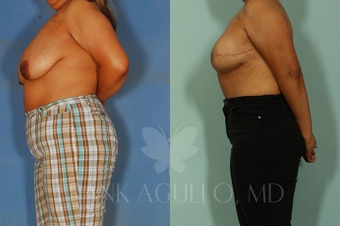 Breast Reconstruction Before and After 4