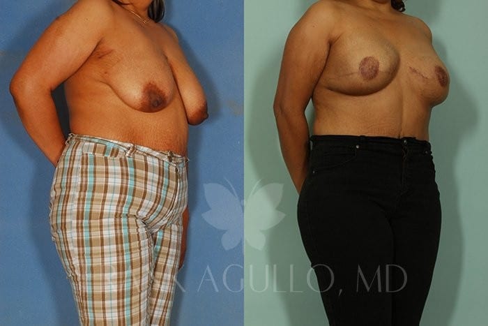 Breast Reconstruction Before and After 5