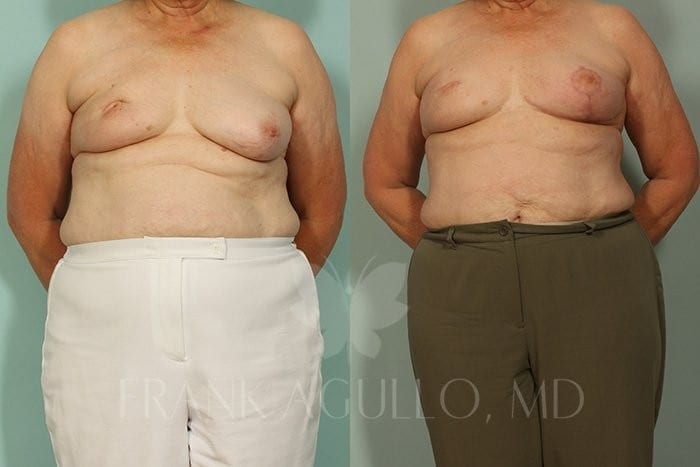 Breast Reconstruction Before and After 5