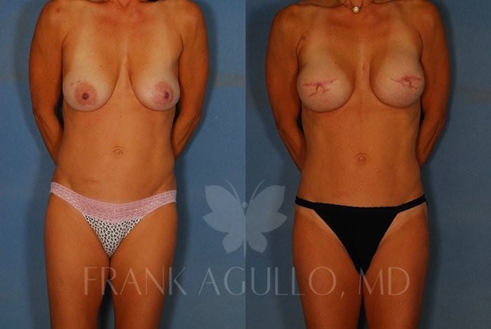 Breast Reconstruction Before and After 4