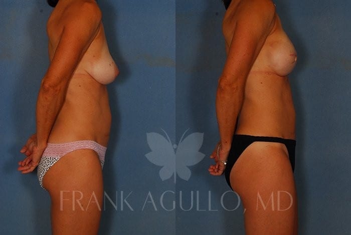 Breast Reconstruction Before and After 4